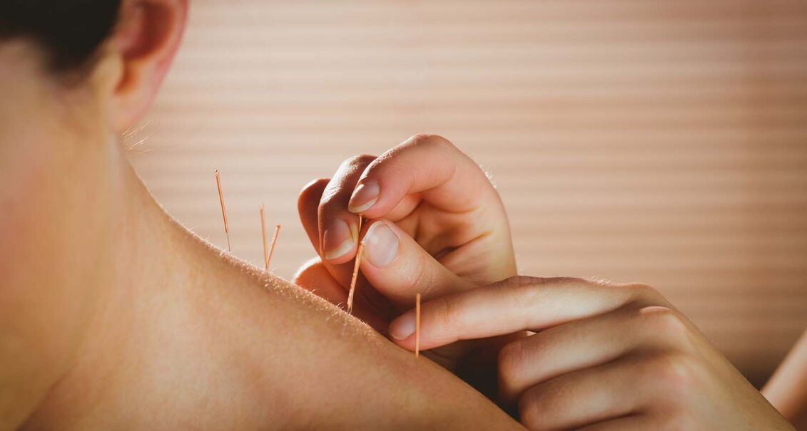 Wat doen ze bij acupunctuur